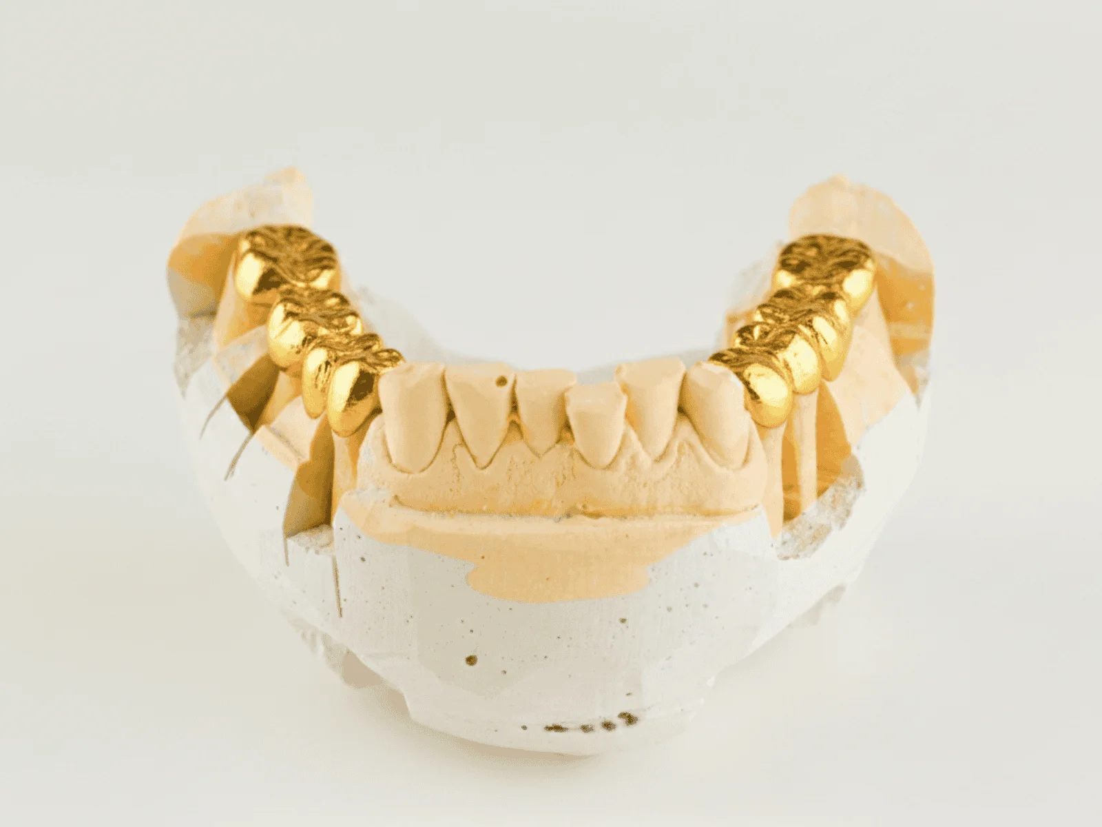 dental gold bridge